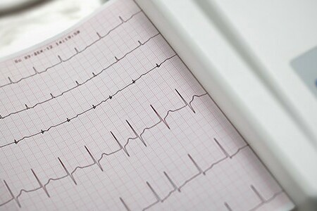 Atrial Fibrillation